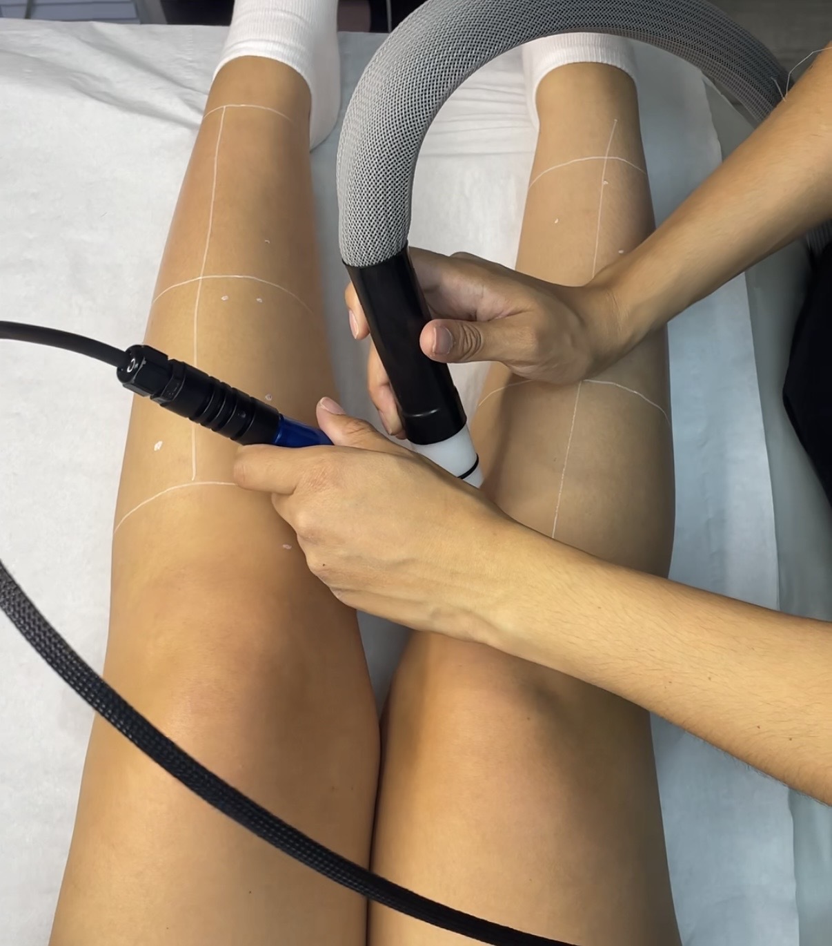 Laser treatment on legs